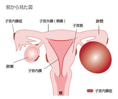 子宮内膜症